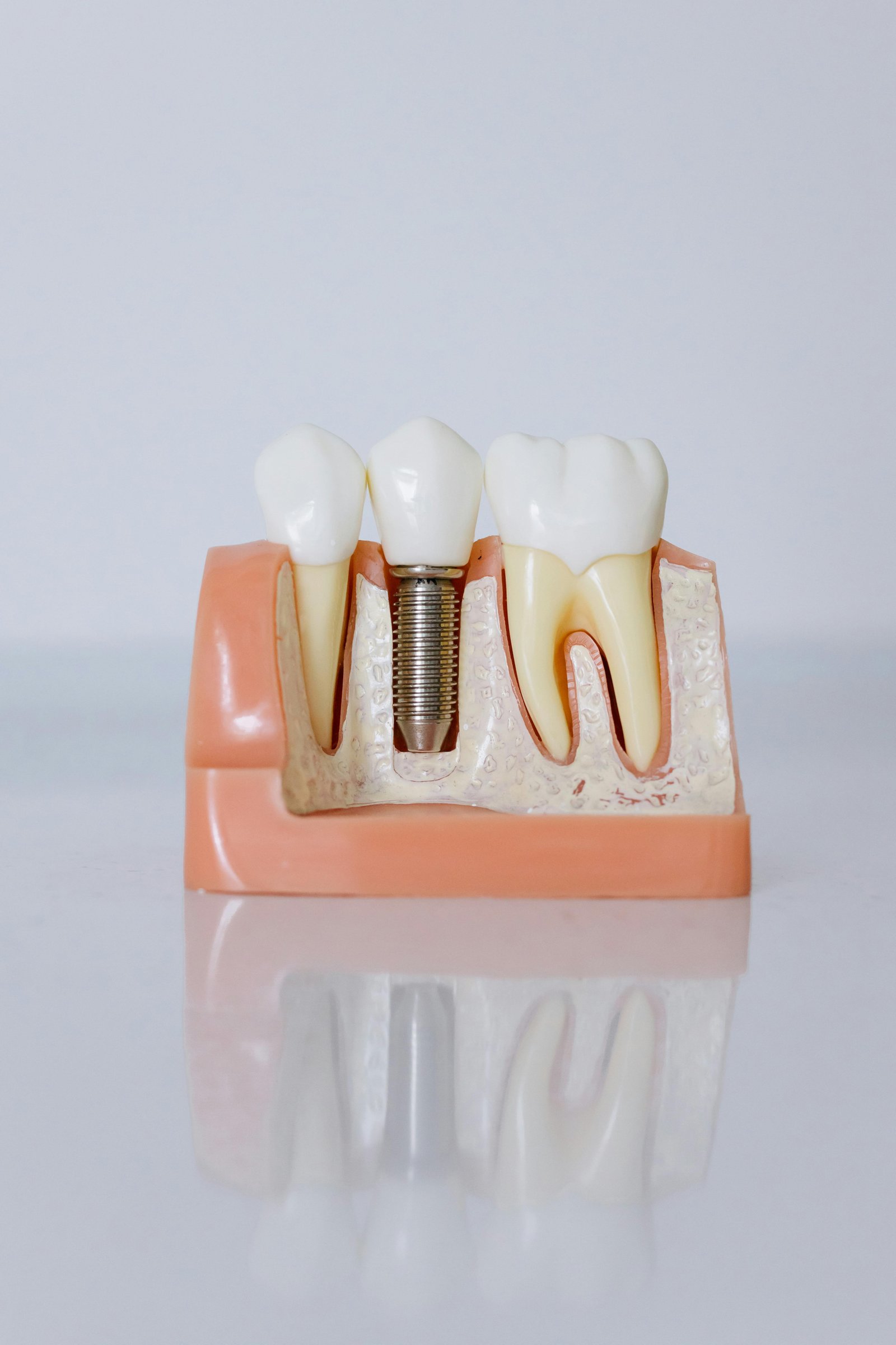 Close-up of a dental implant model